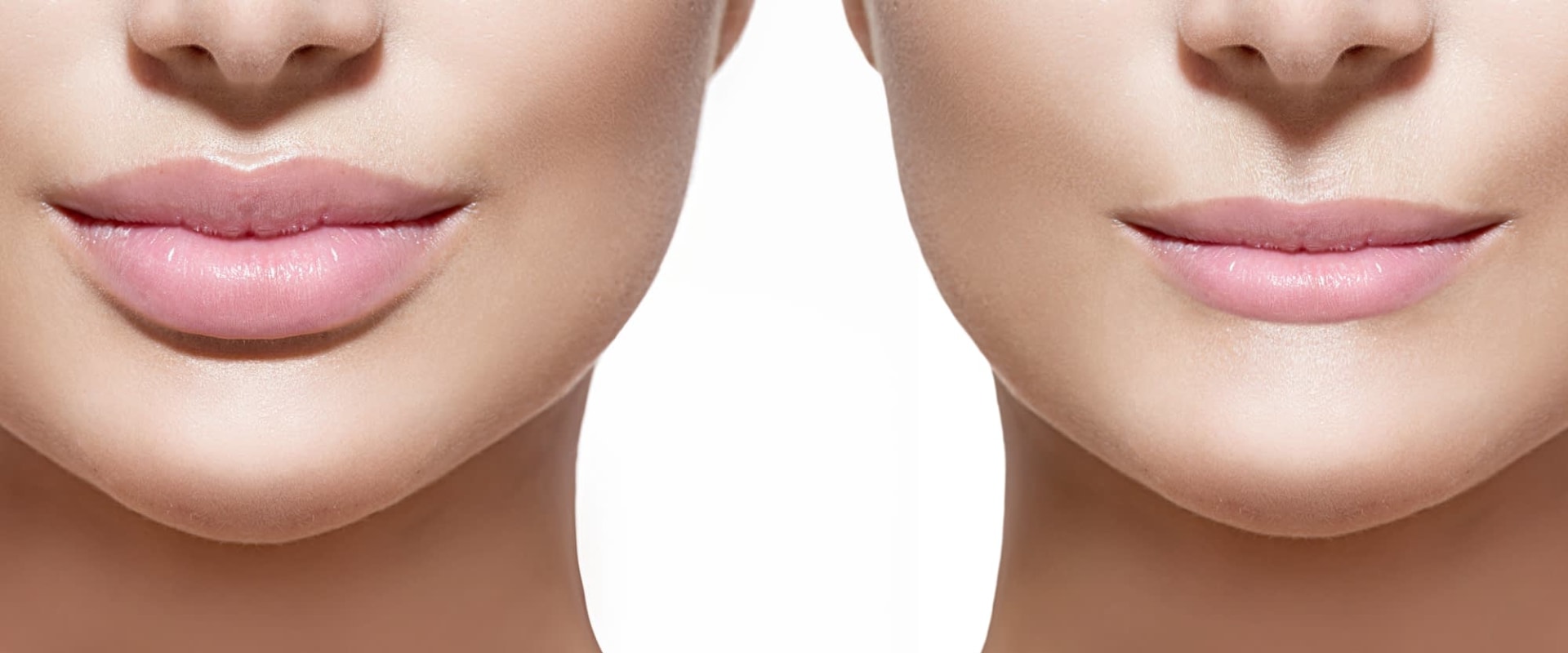 How Long Do Dermal Fillers Last?