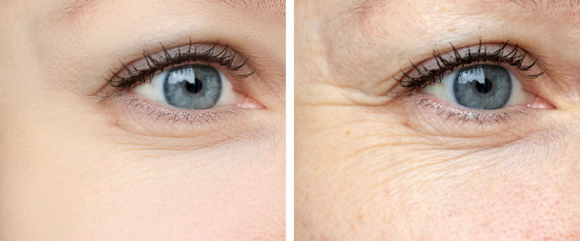 Are Fillers Better Than Botox? An Expert's Perspective