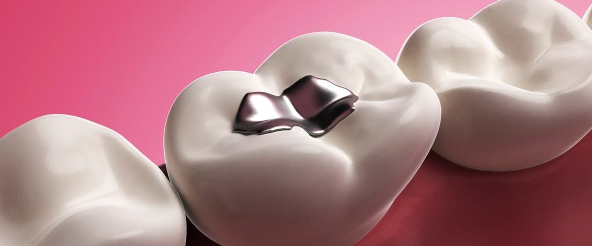 Dissolving Lip Fillers: How Does It Work?