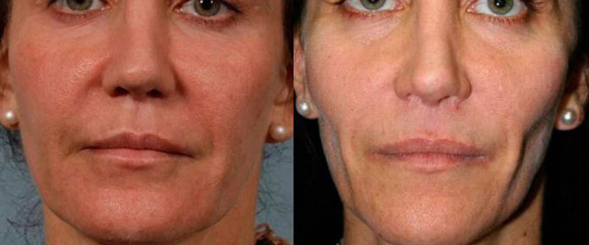 How Long Do Fillers Last?