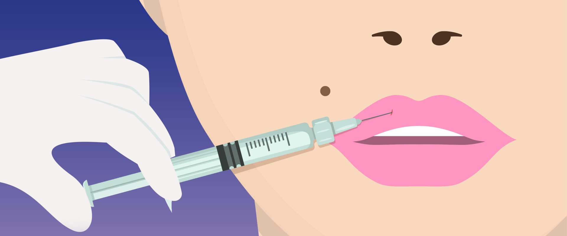 Where Should Filler Injections Be Placed for Optimal Results?
