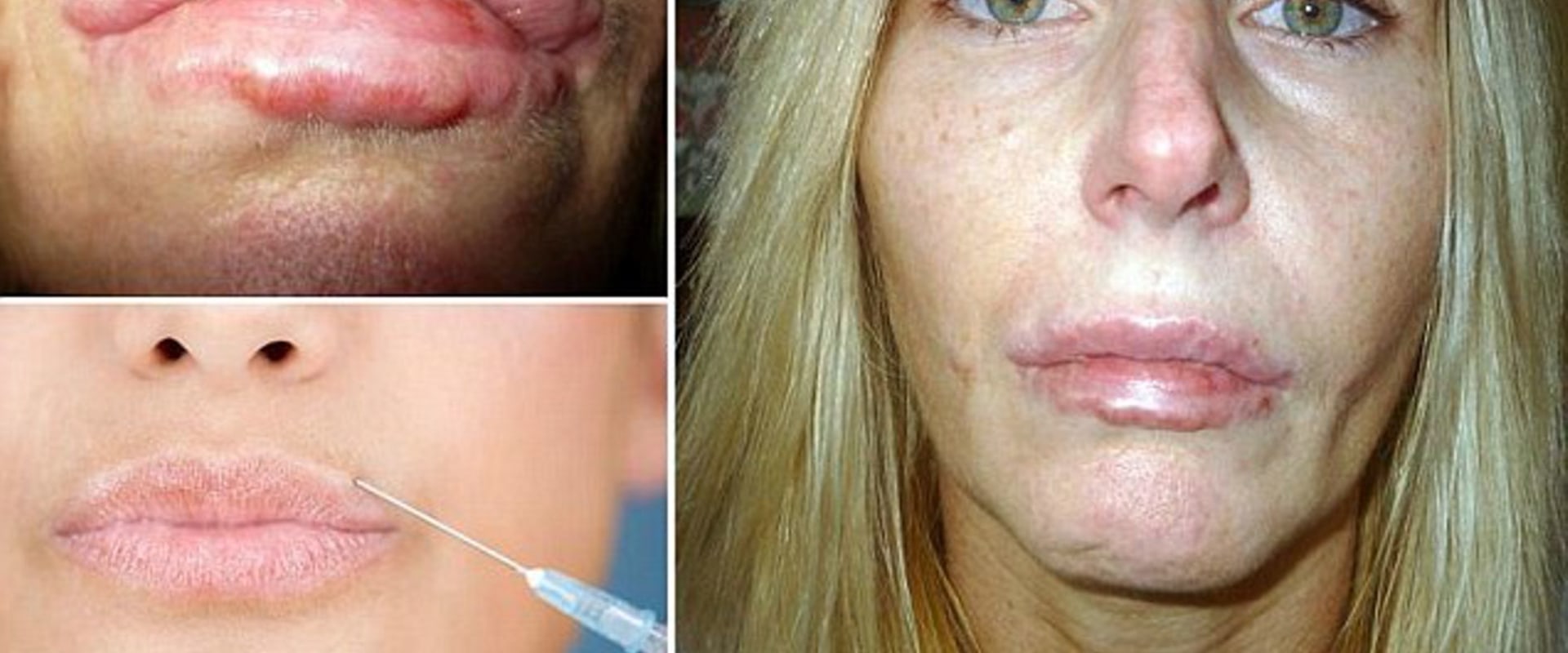 Can Facial Fillers Migrate After Years?