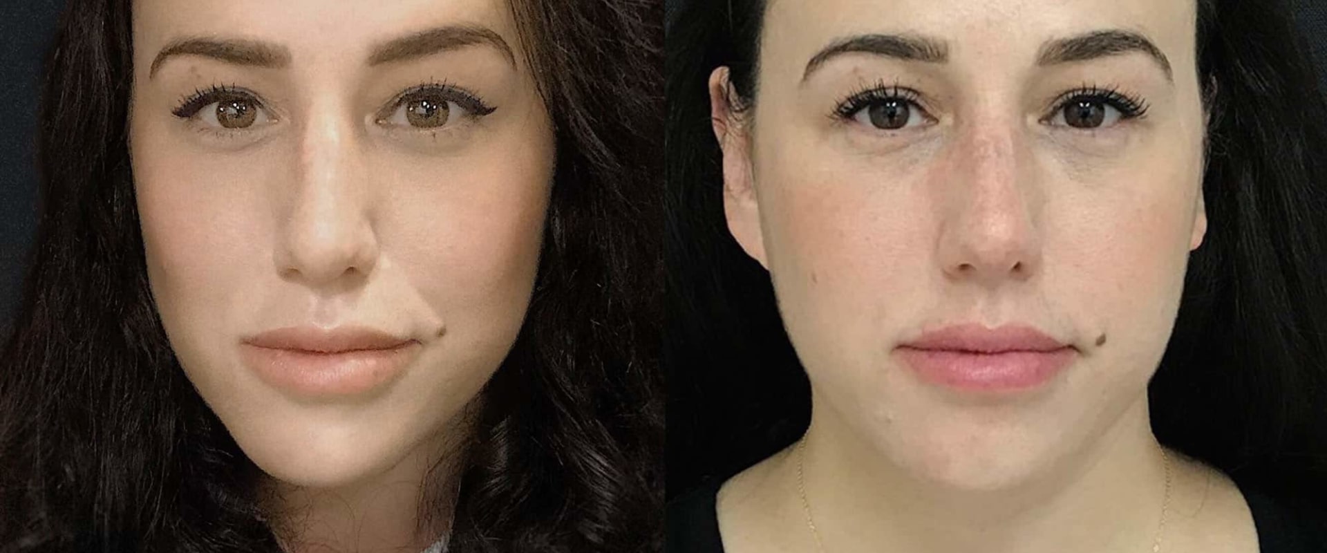 What is the Best Injectable Filler for Cheeks?