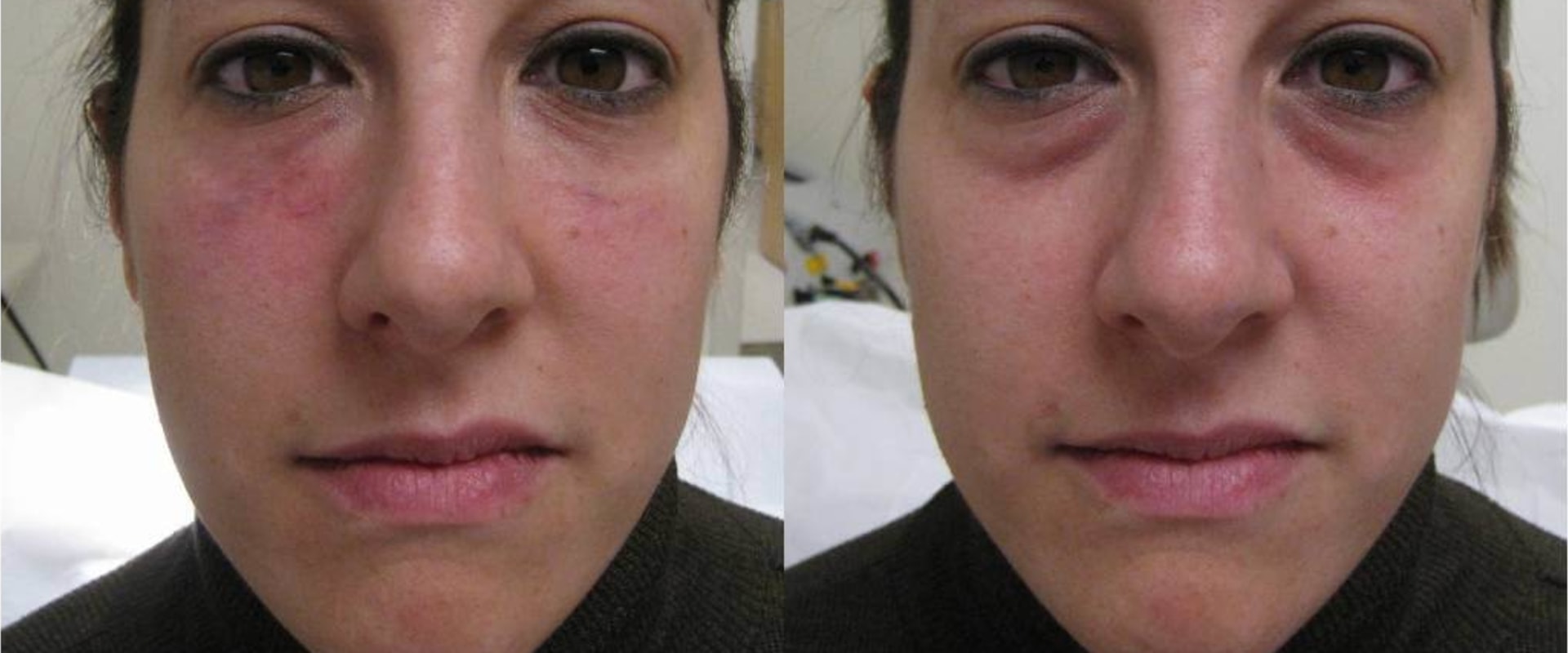 Where Should Dermal Fillers Be Injected? A Comprehensive Guide