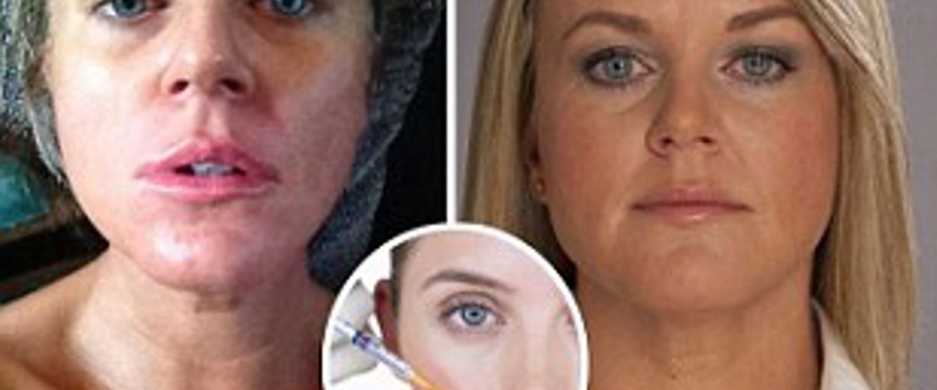 What Happens When Dermal Fillers Wear Out?
