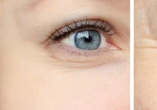 Are Fillers Better Than Botox? An Expert's Perspective