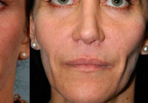 How Long Do Fillers Last?