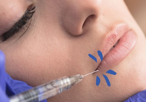 What are the Benefits of Dermal Fillers and Where are They Injected?
