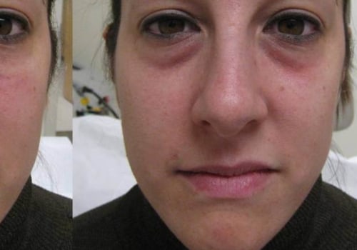 What is Injectable Filler? A Comprehensive Guide