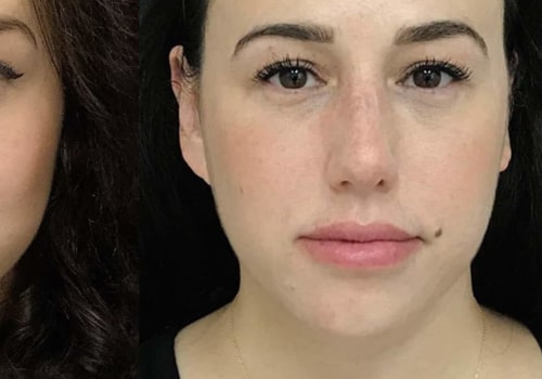What is the Best Injectable Filler for Cheeks?