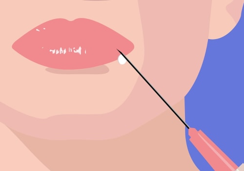Where Does the Filling Go on Your Face? A Comprehensive Guide to Dermal Fillers